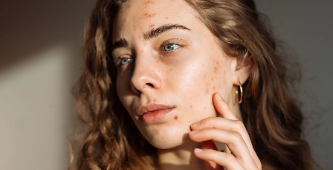 You are currently viewing Blue Light Therapy for Acne: A Proven Solution in Harcourt, ON
